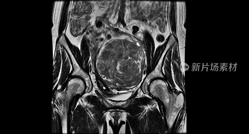 女性骨盆MRI -良性肿瘤子宫肌瘤-术后体重1kg